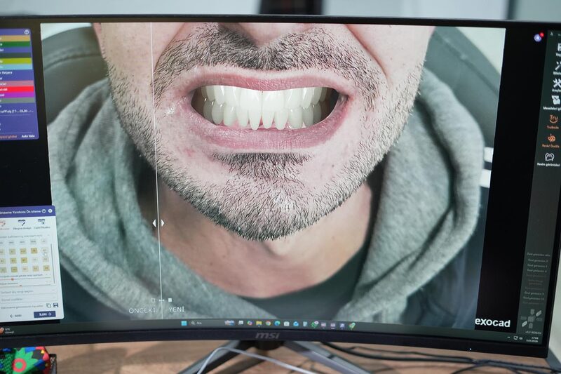 Gülüş Tasarımı - Zürih Diş Gebze